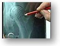 Καλοήθης υπερπλασία του προστάτη αίτια και θεραπεία καλοήθης υπερπλασία του προστάτη αιτιολογία παθογένεια θεραπεία