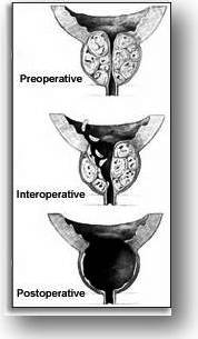 Η χειρουργική θεραπεία εφαρμόζεται στους ασθενείς με έντονα υποκειμενικά ενοχλήματα ή με ηπιότερα χειρουργική θεραπεία υπερπλασία προστάτη