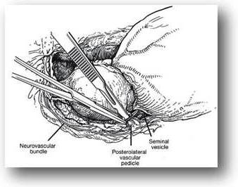 Η εγχείρηση, η προστατεκτομή όπως επικράτησε να λέγεται, γίνεται με ραχιαία συνήθως αναισθησία και με ανοικτή προσπέλαση εγχείρηση διουρηθρική προστατεκτομή καλοήθης υπερπλασία προστάτη