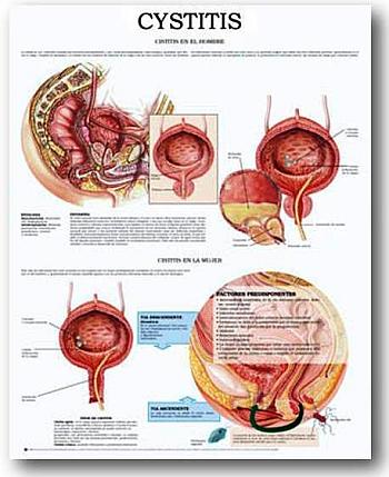 Η οξεία κυστίτιδα ουρολοίμωξη οξεία κυστίτιδα πυρετό θεραπεία